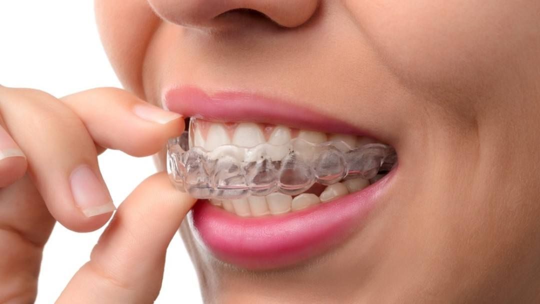https://www.smiledocs.com.au/general-dentists/innaloo/dr-katherine-tan/wp-content/themes/yootheme/cache/woman%20patient%20with%20invisalign%20tray-d474e5c0.jpeg