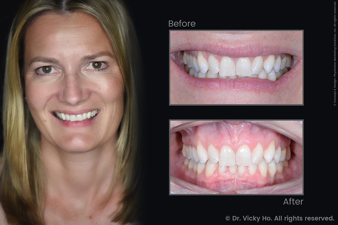 Invisalign Clear Aligners for Crowded, Crooked Teeth