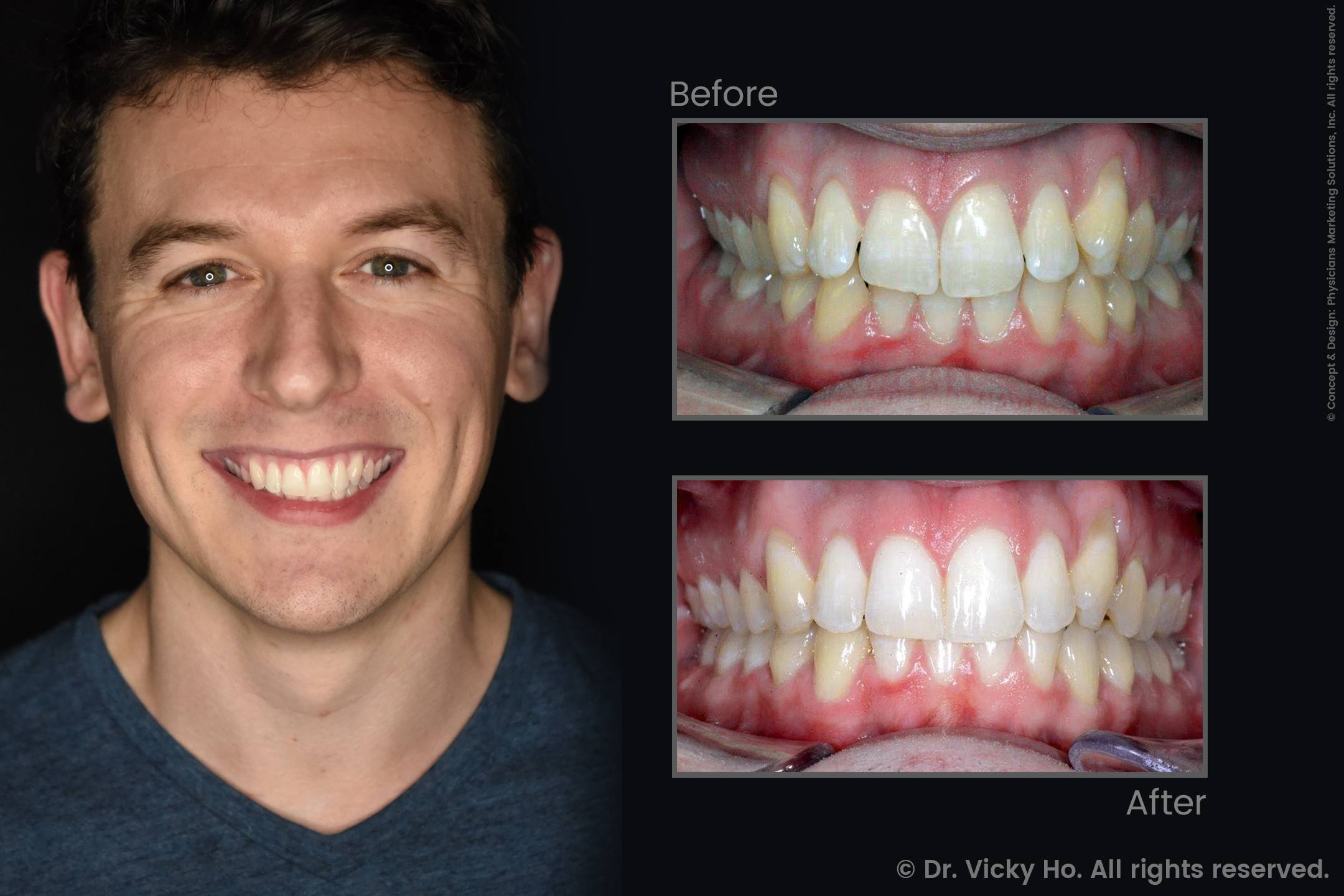 Protruding Teeth Treated with Invisalign