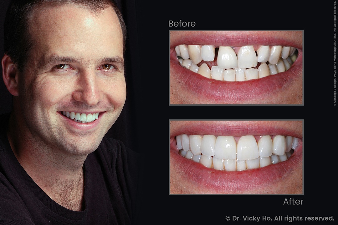 Teeth Treated with Crowns, Veneers and Laser Gum Lift